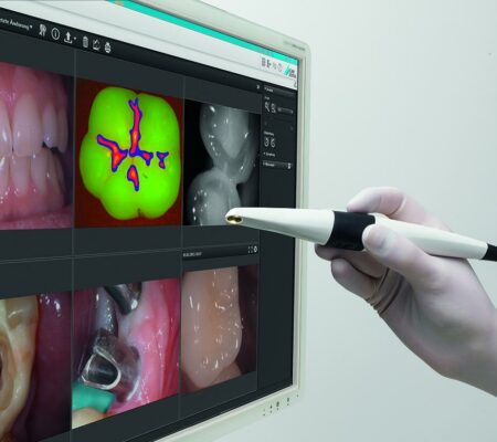 Diagnosi pecoce carie Vistacam Durr