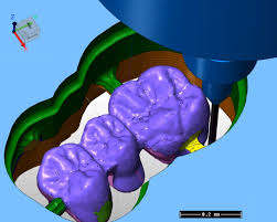 cad-cam in protesi dentale