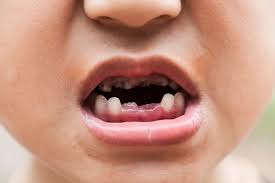 carie denti bambini